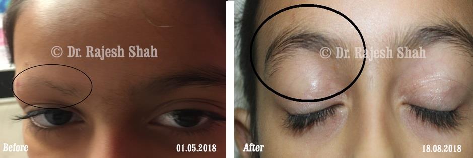 Alopecia Areata Before and After Case Photo