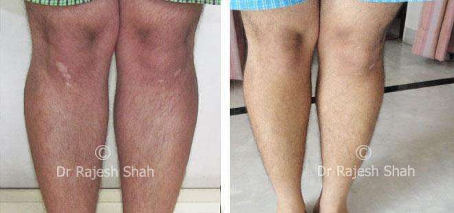 Vitiligo Before and After Case Photo
