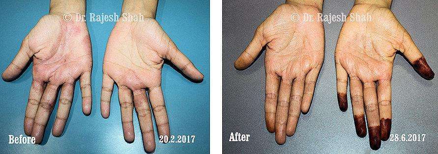 Psoriasis Before and After Case Photo