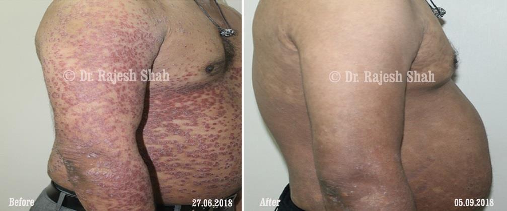 Psoriasis Before and After Case Photo