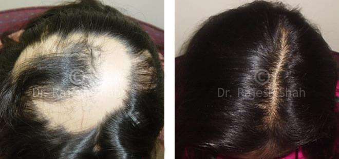 Alopecia Areata Before and After Case Photo