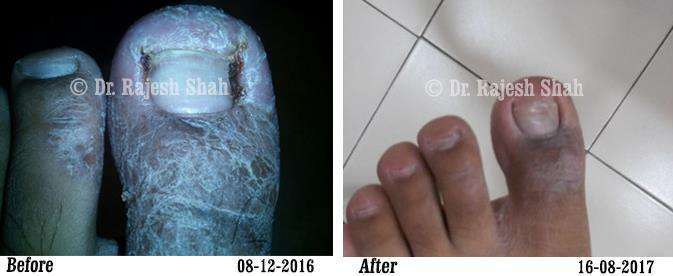Psoriasis Before and After Case Photo