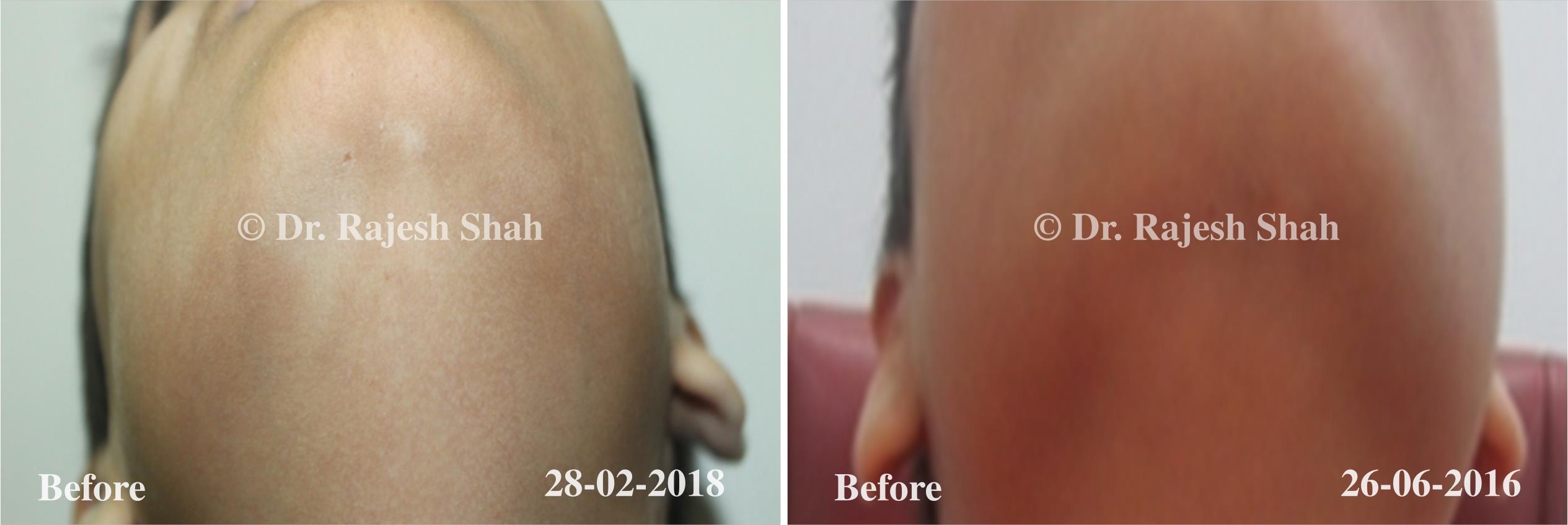 Pityriasis Alba Before and After Case Photo