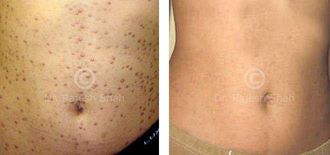 Lichen Planus Before and After Case Photo