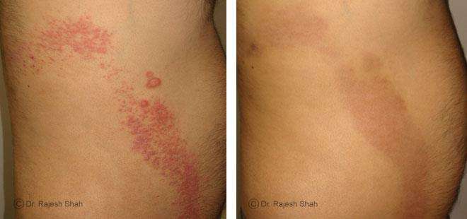 Psoriasis Before and After Case Photo