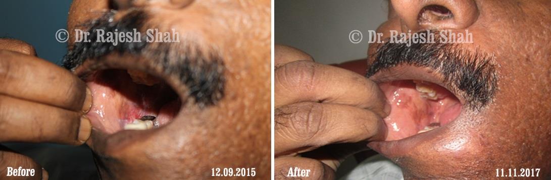 Lichen Planus Before and After Case Photo