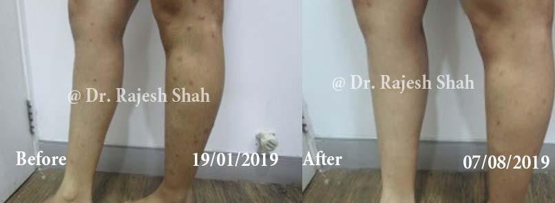 Psoriasis Before and After Case Photo