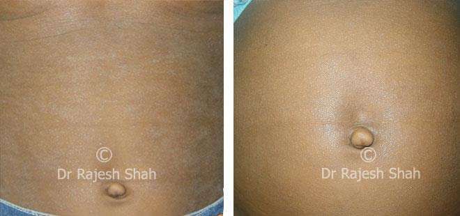 Atopic Dermatitis Before and After Case Photo