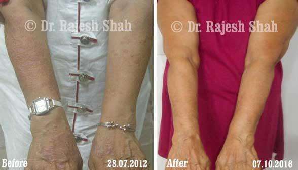 Granuloma Annulare Before and After Case Photo