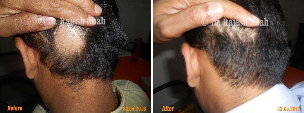 Alopecia Areata