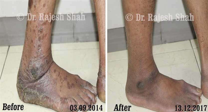 Psoriasis Before and After Case Photo