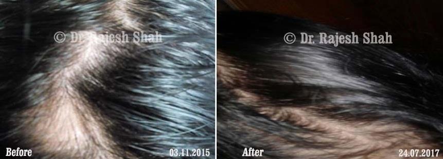Alopecia Areata Before and After Case Photo