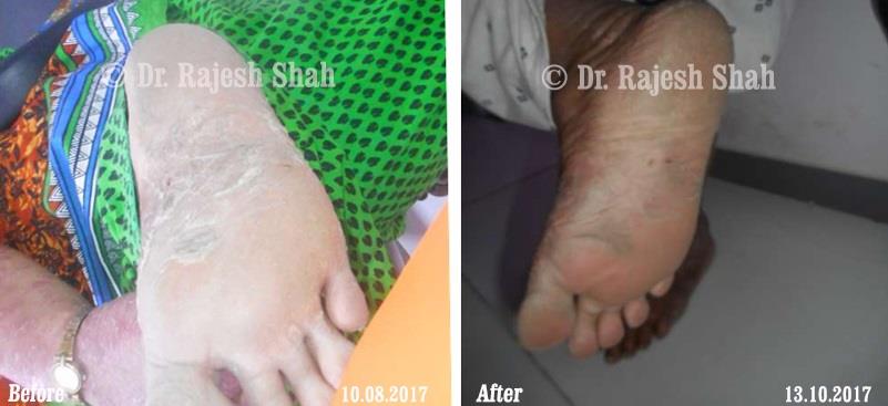 Psoriasis Before and After Case Photo