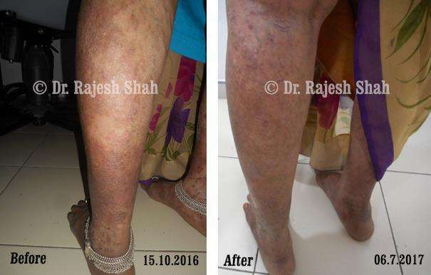 Psoriasis Before and After Case Photo