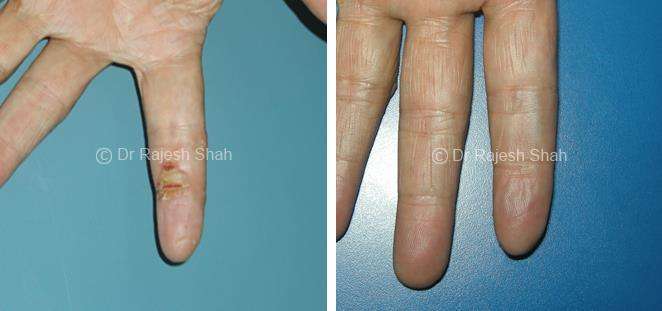 Atopic Dermatitis Before and After Case Photo