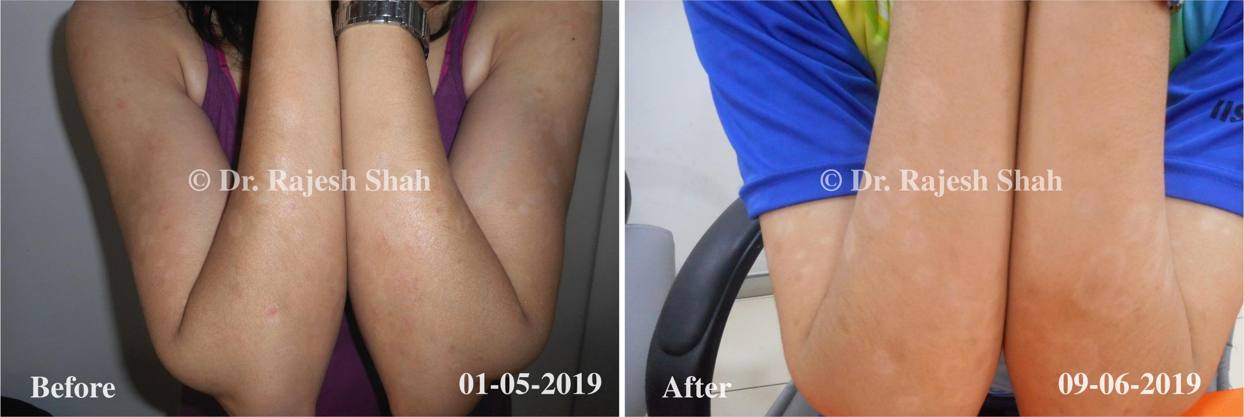 Psoriasis Before and After Case Photo