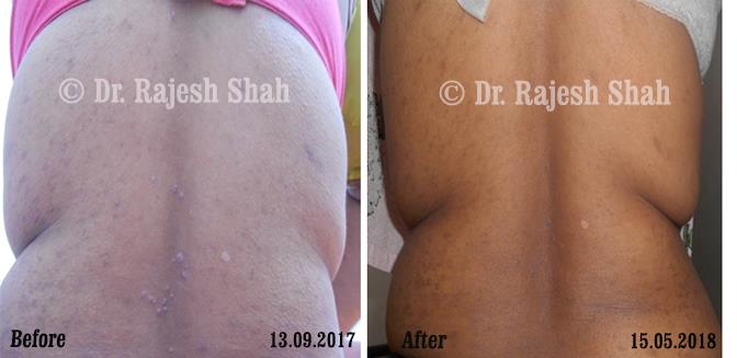 Lichen Planus Before and After Case Photo