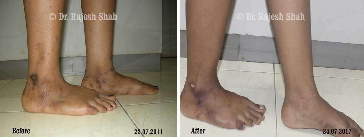 Lichen Planus Before and After Case Photo