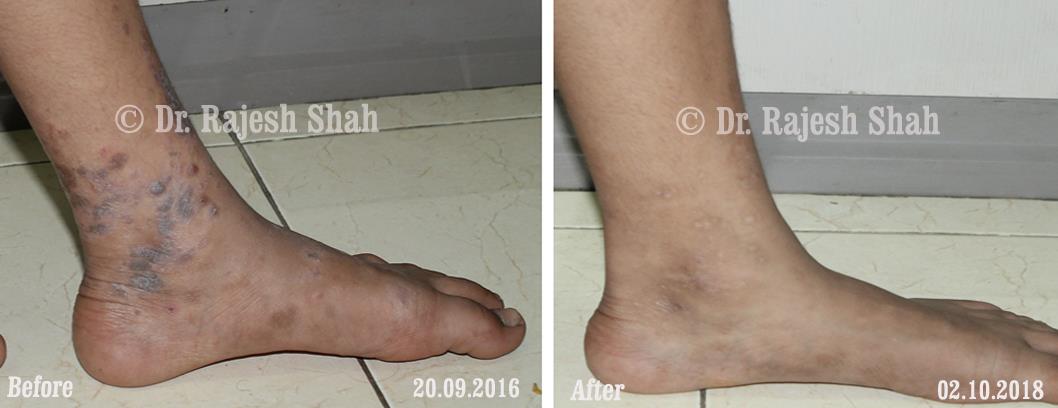 Lichen Planus Before and After Case Photo