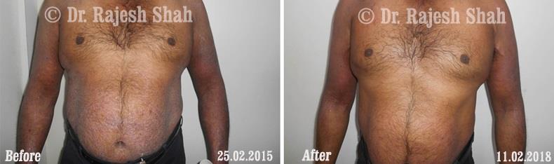 Psoriasis Before and After Case Photo