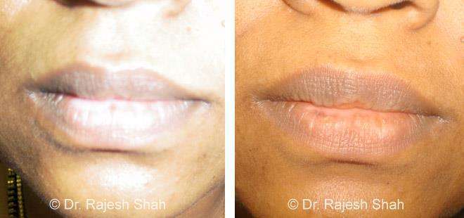 Vitiligo Before and After Case Photo