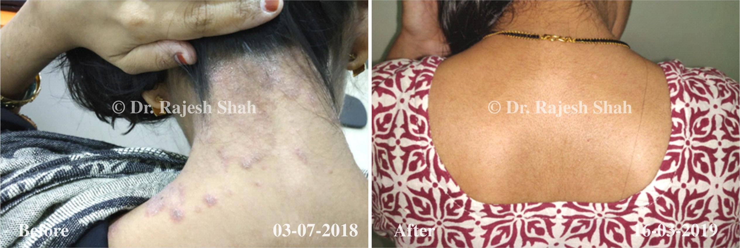 Psoriasis Before and After Case Photo