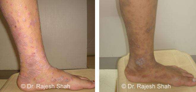 Lichen Planus Before and After Case Photo