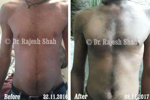 Psoriasis Before and After Case Photo