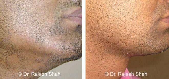 Alopecia Areata Before and After Case Photo