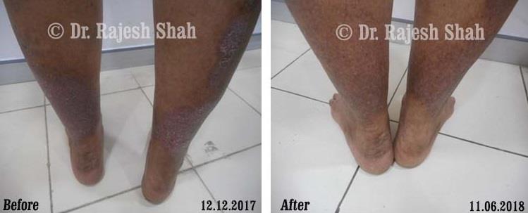 Psoriasis Before and After Case Photo