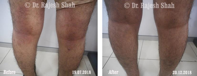 Atopic Dermatitis Before and After Case Photo