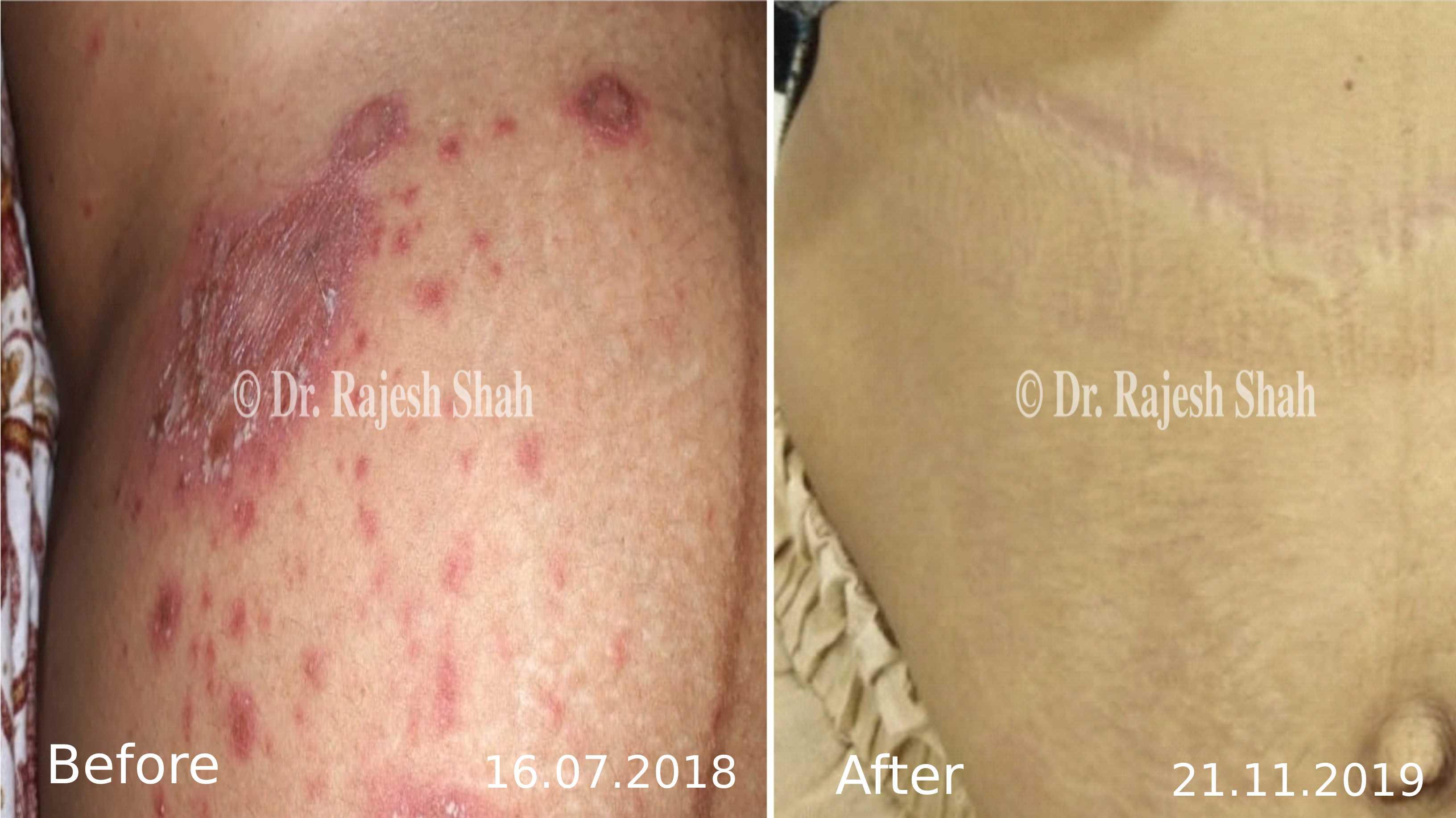 Psoriasis Before and After Case Photo