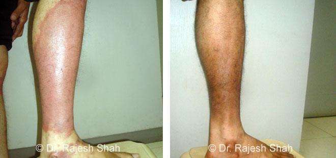 Psoriasis Before and After Case Photo