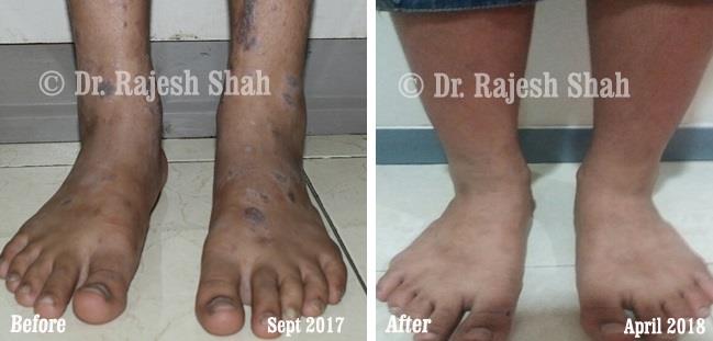 Lichen Planus Before and After Case Photo