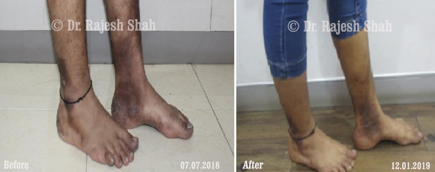 Psoriasis Before and After Case Photo