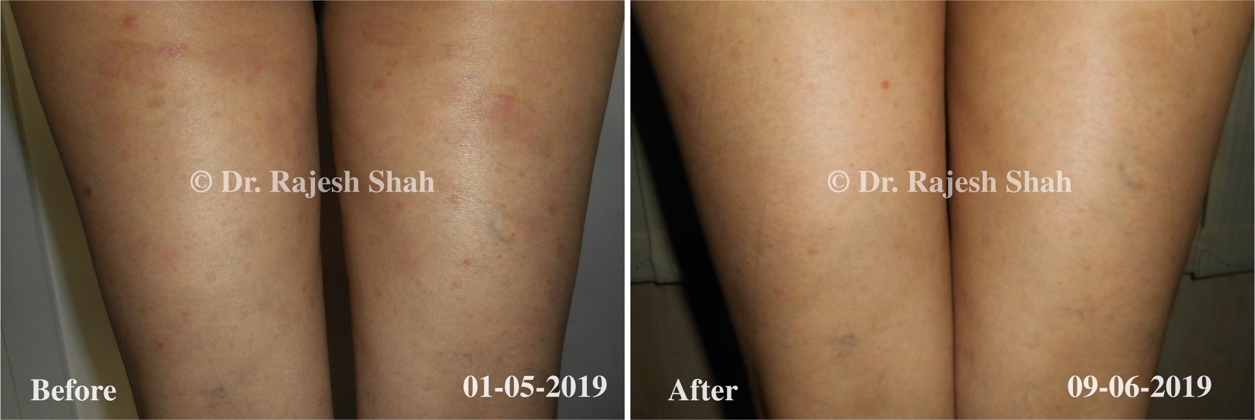 Psoriasis Before and After Case Photo