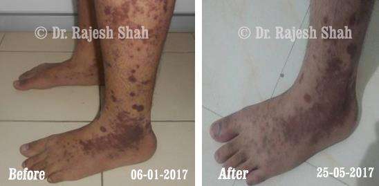 Lichen Planus Before and After Case Photo