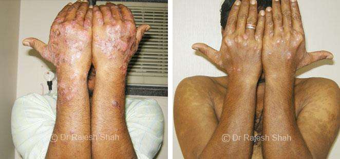Psoriasis Before and After Case Photo