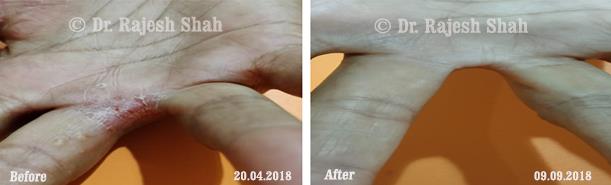 Psoriasis Before and After Case Photo