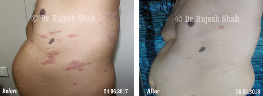 Psoriasis Before and After Case Photo