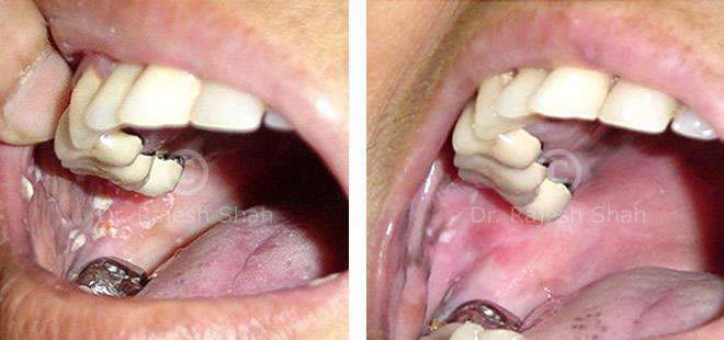Lichen Planus Before and After Case Photo
