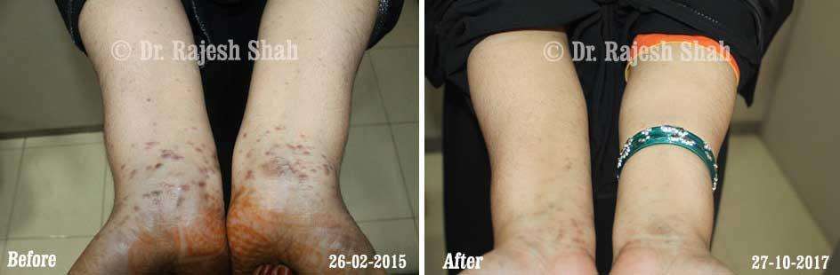 Lichen Planus Before and After Case Photo