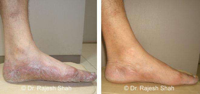 Psoriasis Before and After Case Photo