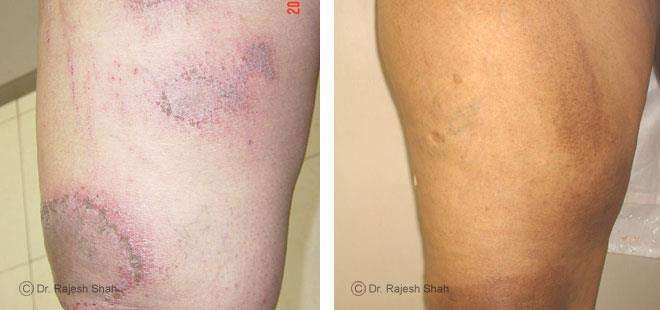 Eczema Before and After Case Photo