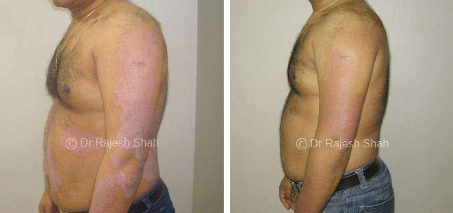 Psoriasis Before and After Case Photo
