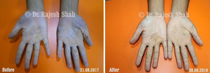 Psoriasis Before and After Case Photo