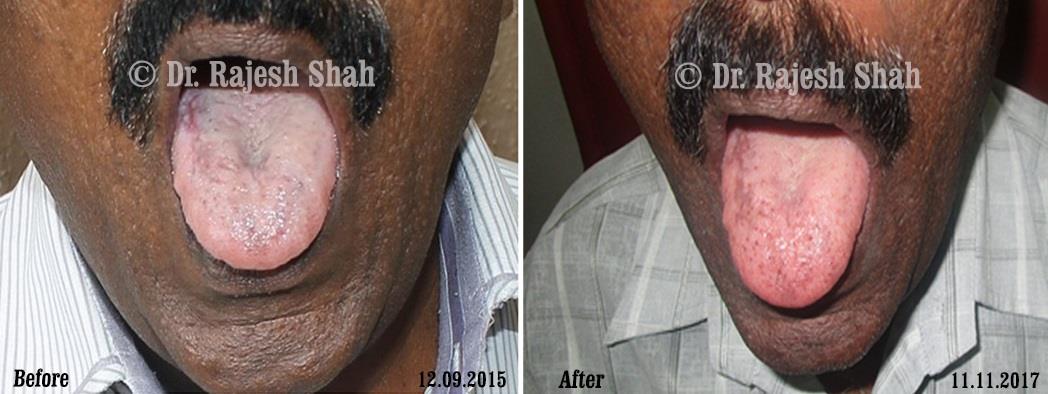 Lichen Planus Before and After Case Photo