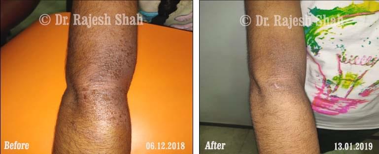 Atopic Dermatitis Before and After Case Photo