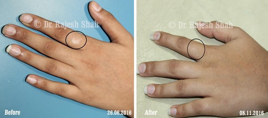 Vitiligo Before and After Case Photo