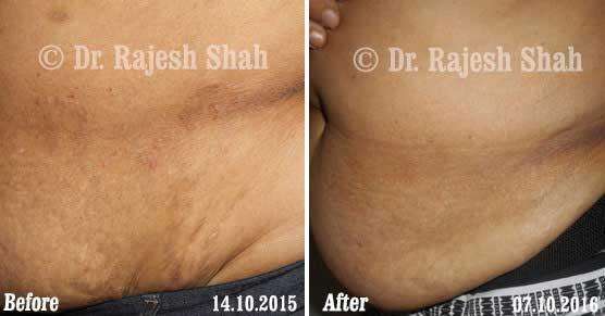 Granuloma Annulare Before and After Case Photo